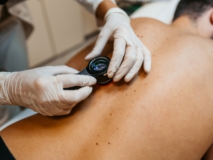 Skin Cancer